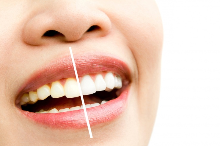 Smile Design