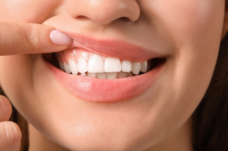 Gum Depigmentation
