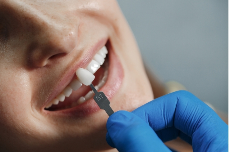 Zirconia Crowns